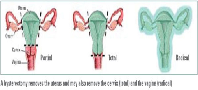 Hysterectomy Discharge Instructions